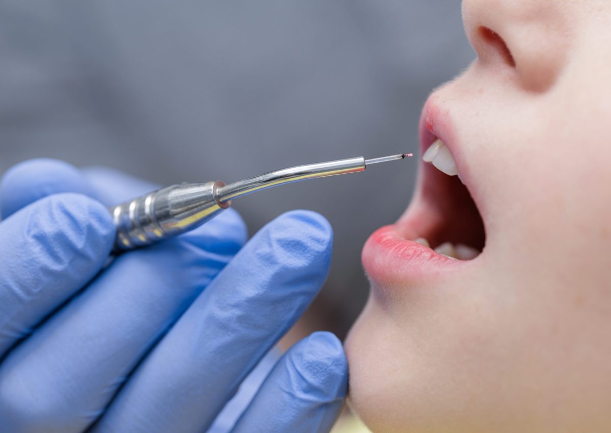 Close,Up,Of,A,Diode,Laser,Tip,Near,A,Childs